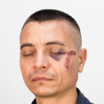 Injured_Bruises Injured_Bruises