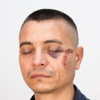 Injured_Bruises