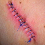 Stitches_Infection Stitches_Infection